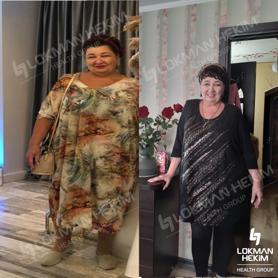 Gastric bypass surgery